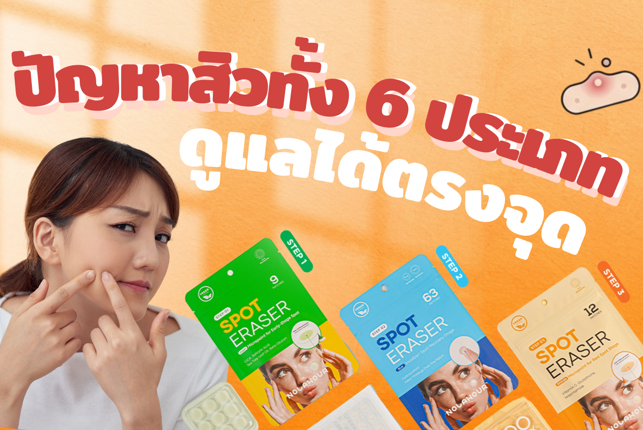 ปัญหาสิวทั้ง 6 ประเภท ดูแลได้ตรงจุด ผิวใสโดยไม่ต้องพึ่งฟิลเตอร์